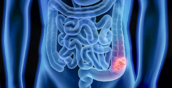 Mais de 170 portugueses testaram positivo em campanha nacional contra o cancro colorretal