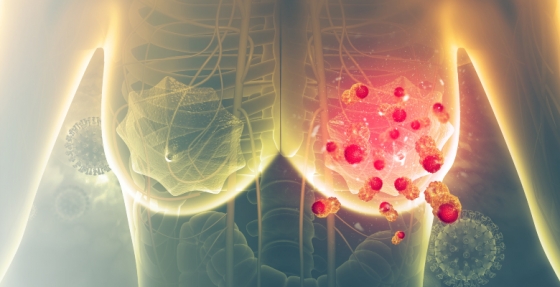 Cancro da mama precoce: panorama do tratamento adjuvante da doença HER2+