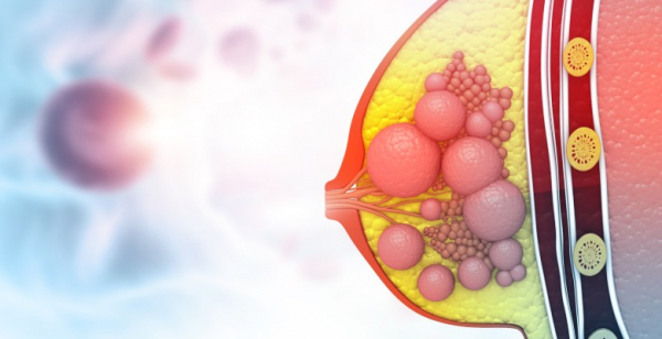 TNBC: benefício da associação pembrolizumab + quimioterapia em doentes com PD-L1 CPS ≥10