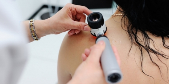 CHMP emite opinião positiva para tratamento com encorafenib + binimetinib em doentes adultos com melanoma avançado BRAF+