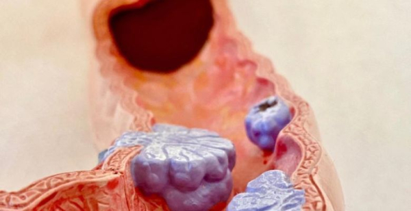 Taxa de adesão ao rastreio do cancro do cólon caiu para 41 % em 2022