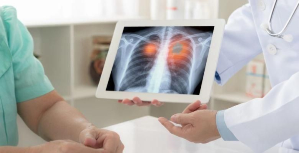 OMS demonstra que cancro do pulmão ressurge como o mais comum em todo o mundo