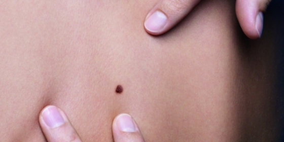 Doentes tratados com encorafenib+binimetinib apresentam sobrevivência global mediana de 33,6 meses