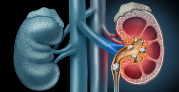 CE aprova pembrolizumab como tratamento adjuvante em monoterapia para adultos com CCR