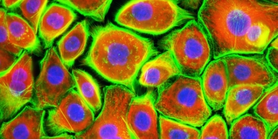 Investigação portuguesa desenvolve método simples para determinar risco de cancro