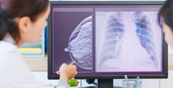 Proteção dos doentes com cancro da mama precoce RH+/HER2- de alto risco – guia prático para a utilização de iCDK4/6 em adjuvância