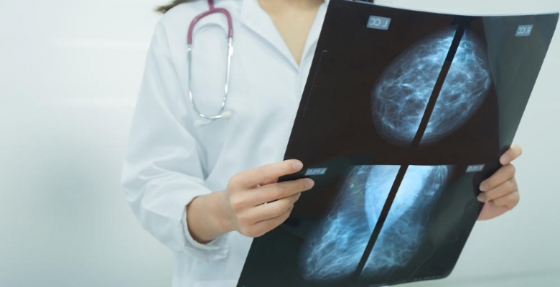 Investigadores portugueses desenvolvem tratamento para cancro da mama agressivo