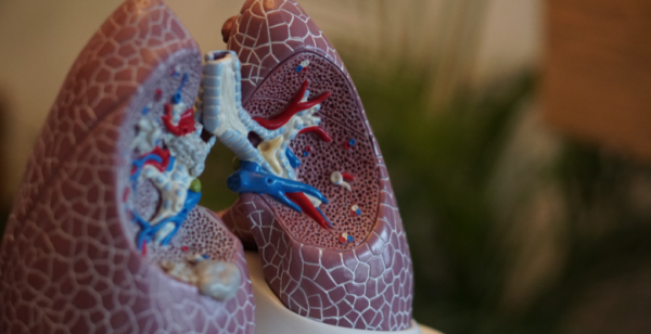 CPNPC não escamoso: estudo de fase II PERLA com resultados positivos com a combinação de dostarlimab e quimioterapia